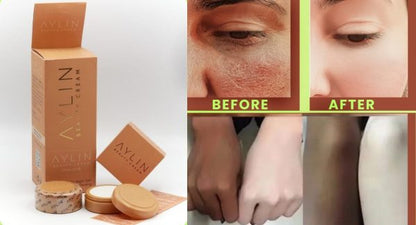 Aylin Beauty Cream | Best Whitening Cream for Face | Removes Acne, Pimples & Blackheads | Original Formula
